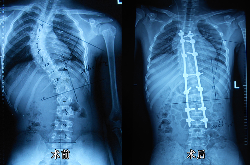 我院脊柱外科成功为15岁男孩实施特发性脊柱侧凸手术