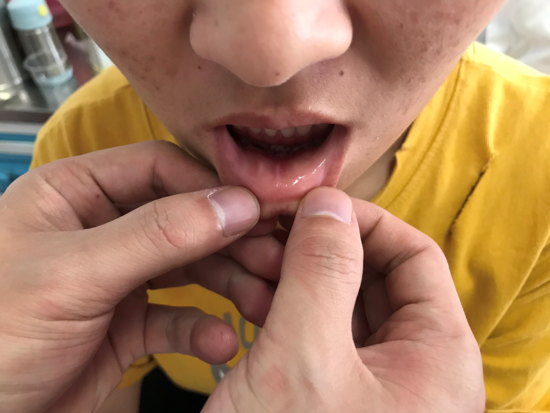 甲状腺外科完成我市首例经口腔前庭入路腔镜甲状腺手术