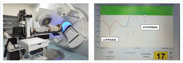 主动呼吸门控放疗技术,让运动的肺"睡着了"