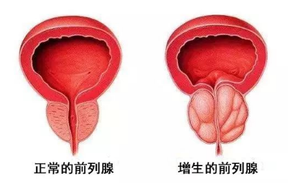 "零出血"解决前列腺增生