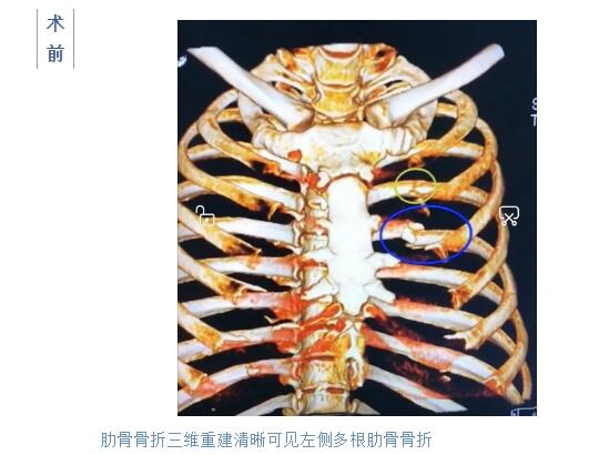 梅州市人民医院不用开胸 我院成功开展粤东首例微创肋骨骨折复位内固定术