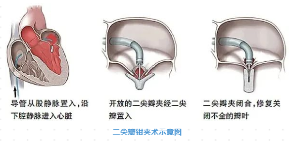 梅州市人民医院钟志雄教授团队自主完成一例经导管二尖瓣钳夹术